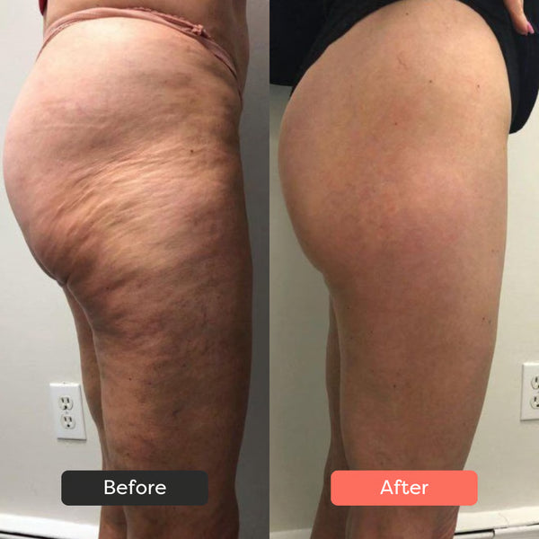 The skin feels much firmer!