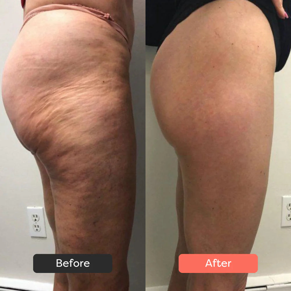 SaviaParis Body Sculpting Device